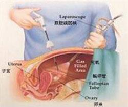 laparoscopic_1