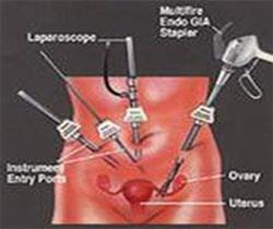 laparoscopic_2