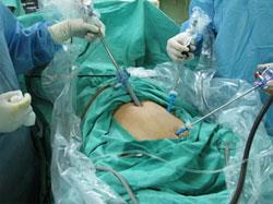 腹腔鏡手術操作過程